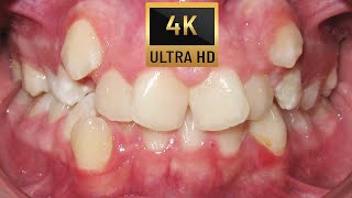 HOW BRACES WORK  TIMELAPSE of ECTOPIC CANINES  four premolars extraction case Orthodontics [upl. by Delphinia]