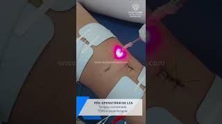 Pósoperatório de LCA  Tens e Laserterapia [upl. by Ettezzus]