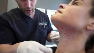 Kybella  Double Chin  Neck Fat  Skin Tightening  Los Angeles California [upl. by Karole]