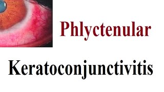 phlyctenular Keratoconjunctivitis [upl. by Ylim]