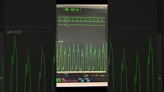 Right Heart Catheterization study with swan ganz catheter [upl. by Ok]