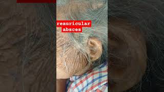 preauricular abscess [upl. by Gautious32]