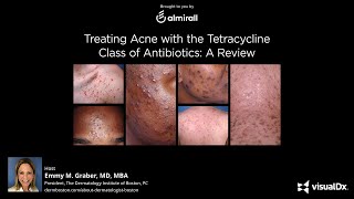 Treating Acne with the Tetracycline Class of Antibiotics A Review [upl. by Tab]