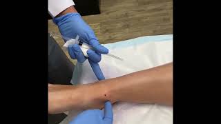 IntraArticular ankle injection [upl. by Indyc]