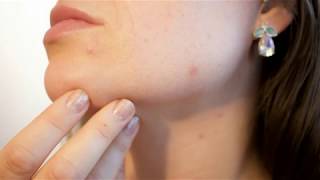 Difference Between Acne and Herpes [upl. by Adiela]