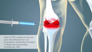 TLC599 Intraarticular Injection for Osteoarthritis Pain [upl. by Castera]