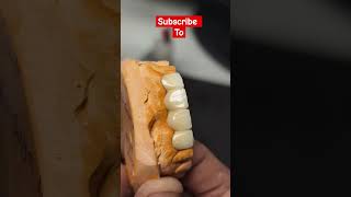 Ceramic Crown vs Porcelain Crown🦷 dentist ceramicbuildup CeramicCrown [upl. by Suixela]