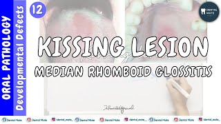 Median rhomboid glossitis  Kissing lesion  Central papillary atrophy  Dr Paridhi Agrawal [upl. by Idnarb515]