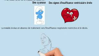 Tout Savoir Sur La Fibrose Pulmonaire Idiopathique [upl. by Enerehs869]