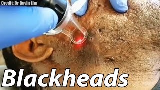 Worst Cystic Acne Biggest Blackheads and GIANT Cyst Removal [upl. by Abner]