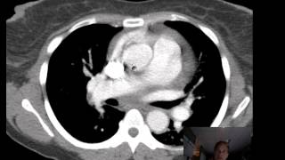 CT Chest Right Heart Failure Discussed by Radiologist [upl. by Rimat]