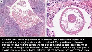 Enterobius vermicularis Madenwurm im Appendix [upl. by Ecinrahs938]