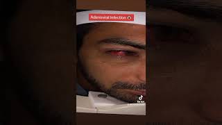 Adenoviral Eye Infection pinkeye ashobechashm ashob eye eyecarecentre eyedisorder lashes [upl. by Iaka204]