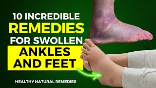 10 Incredible Remedies For Swollen Ankles and Feet [upl. by Kcinemod]