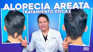 TRATAMIENTO EFICAZ PARA ALOPECIA AREATA [upl. by Kylander]