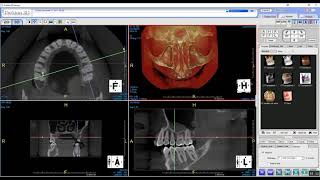 Prexion Excelsior CBCT 8X15 scan [upl. by Sitra771]