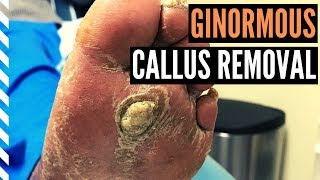 Ginormous Callus Removal [upl. by Horner]