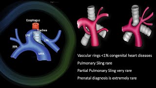 Unveiling the Mystery Fetal Pulmonary Vascular Ring and the Anomalous Left Pulmonary Artery [upl. by Nevyar]