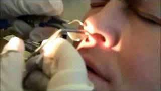 WORLDS BIGGEST BOOGER PULLED OUT OF NOSE DISTURBING [upl. by Aicyla]