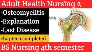 osteomyelitis causes symptoms diagnosis treatment amp pathology in Urdu and Hindi Disorderlast [upl. by Rosario]