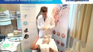 Dermapen 4 Treatment Melasma [upl. by Esau]