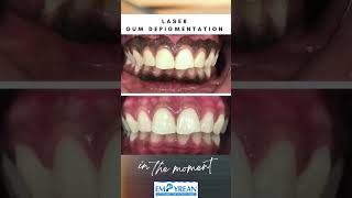 From Black Gums to Pink Gums depigmentation shorts viralvideo trending dental smilemakeover [upl. by Purpura]