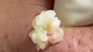 Acne Treatment Huong Da Nang  2024 blackheads 708 [upl. by Nylssej689]