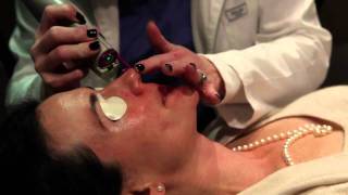 Laser treatment for Rosacea Birmingham Alabama  Cosmetic Dermatology [upl. by Aretha]