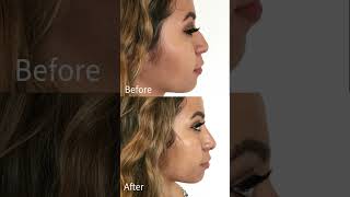 Get your nose ready nonsurgicalrhinoplasty liquidrhinoplasty nonsurgical [upl. by Ammann227]