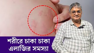 Urticaria  Causes Symptoms Treatment  Skin Rash  এলার্জি থেকে মুক্তির উপায়  ত্বকে চুলকানি [upl. by Bobbi]