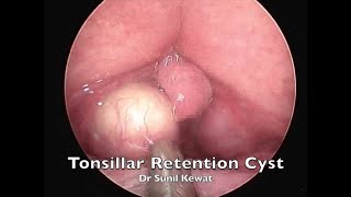 Tonsillar Retention Cyst  Incision and Drainage  Dr Sunil Kewat [upl. by Anad]