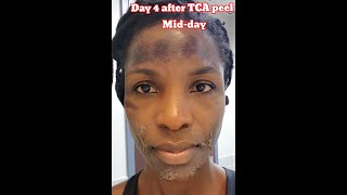 tcapeel shorts  TCA PEEL AT HOME BEFORE amp AFTER DAY 1 TO DAY 10 PART 1  FOLLOW amp COMMENT FOR PT2 [upl. by Coridon]