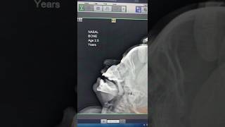 Xray Nasal bone Fracture anatomy xraytechnician shoulderanatomy doctor xray [upl. by Hathcock]