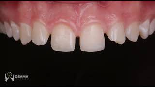 Smile makeover with direct veneers and simple managment of multiple diastema [upl. by Macintyre]