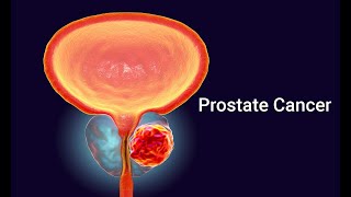 prostate cancer 5 biopsy technique Gleason pattern Gleason score grading system and staging [upl. by Aiuqet]