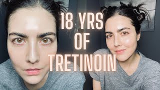 Not Seeing Results with RetinA TRETINOIN Watch This Before You Quit amp Avoid My Biggest Mistake [upl. by Cordeelia652]