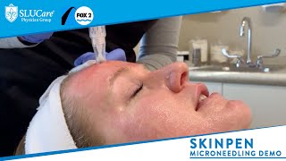 Skinpen Microneedling How it Works amp Demonstration  SLUCare MedSpa [upl. by Adikam]