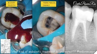 one visit endodontic treatment one curve micromega irreversible pulpitis perawatan saluran akar [upl. by Lundin326]