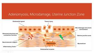 Natural Care for Adenomyosis [upl. by Leta483]