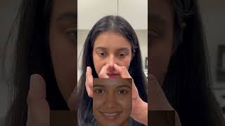 3 month rhinoplasty result  Anthony Bared MD FACS  Miami FL [upl. by Eidnar]