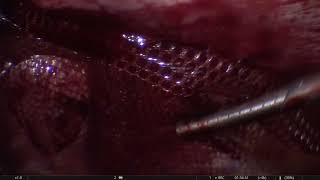 Laparoscopic Ventral Hernioplasty 24 Uzma [upl. by Froma]