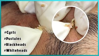 Big Cystic Acne Blackheads Extraction Blackheads amp Milia Whiteheads Removal Pimple Popping [upl. by Hannavahs]