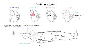 Approach to Shock  types hypovolemic cardiogenic distributive anaphylaxis pathology treatment [upl. by Haletky]