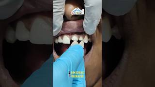 For front teeth only Zirconia Crowns zirconiacrowns rudrapurdental dentist youtubeshorts [upl. by Anaicul]