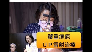 協同式痘疤治療UP雷射UltraPulse的分段式治療 [upl. by Sukey413]