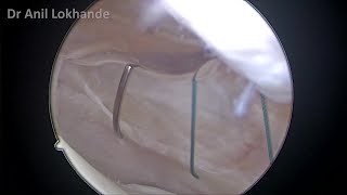 Arthroscopic Medial Retinaculum Plication amp Lateral Release Patella by Dr Anil Lokhande [upl. by Scott]