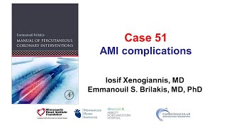 Case 51 PCI Manual  MI complications [upl. by Esilahs]