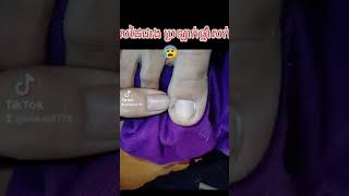 The worst toenail on earth “Thornquot inside the toe nail​​​ asmr fyp ear shorts viral wax [upl. by Nuahsor]