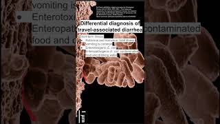 Differential diagnosis of travelassociated diarrhea [upl. by Eissert]