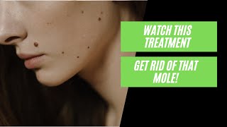 How to remove a mole on your face and neck [upl. by Bahr]